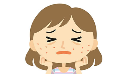adult-acne-2-420